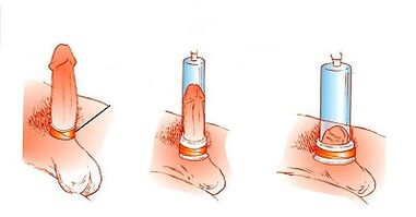 Principles of pump operation to enhance penis