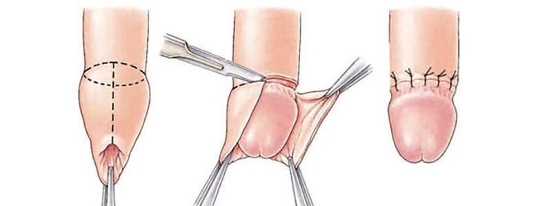 The circumcision effect on the size of the penis